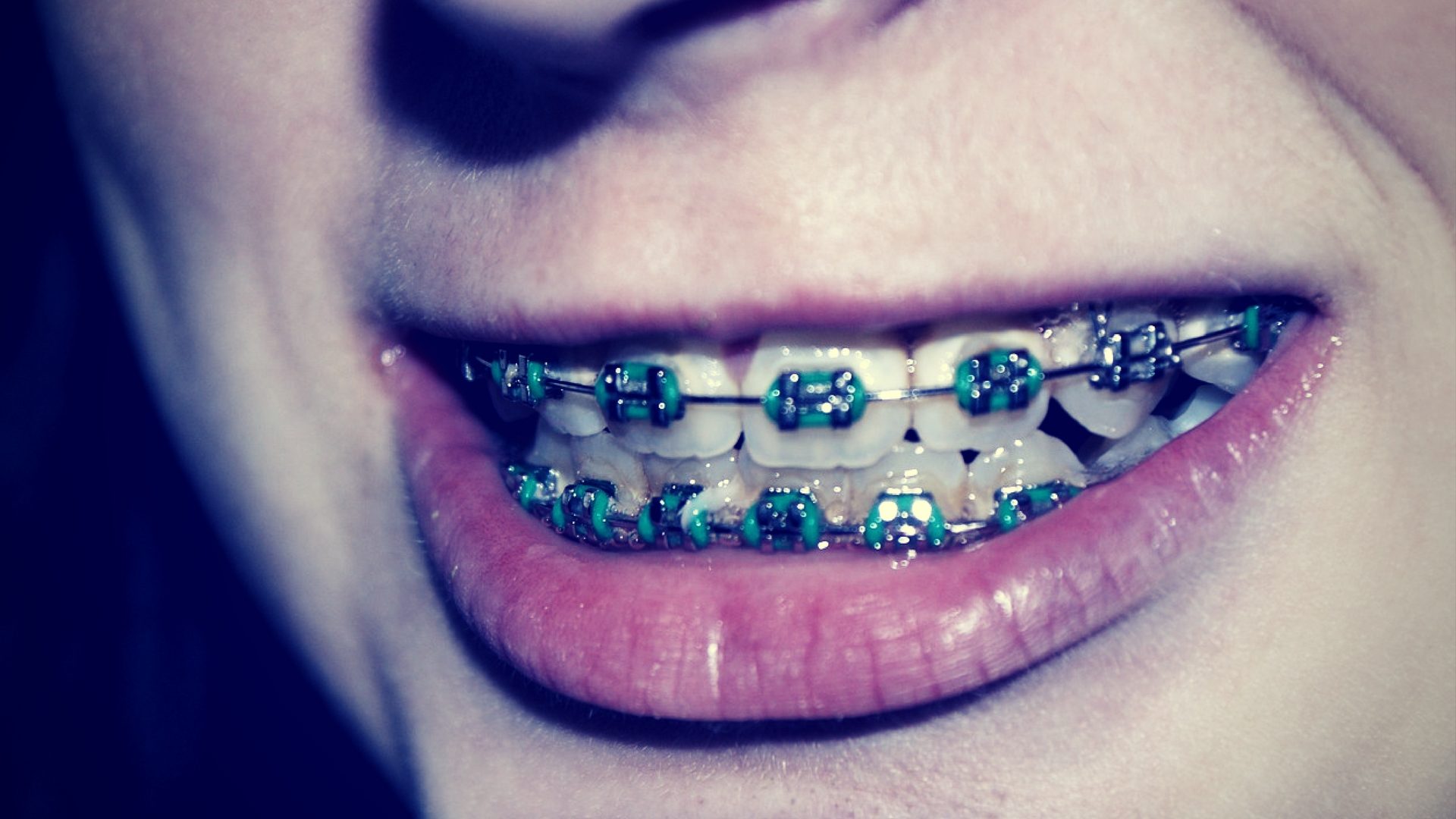 3 Benefits of Braces for Kids