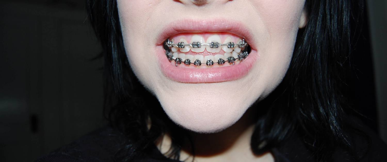 braces, My Journey With Braces As An Adult.