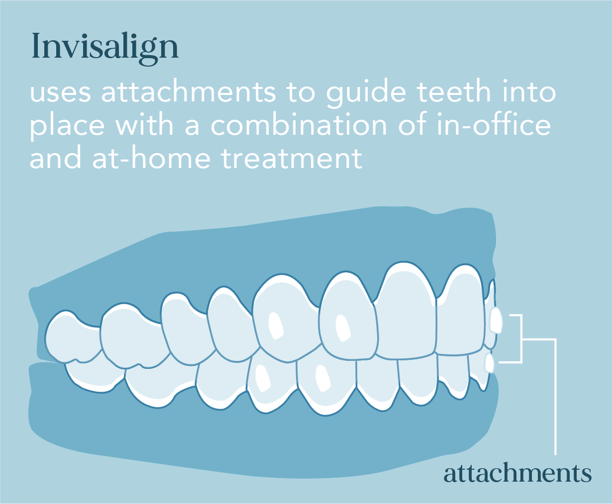 Invisalign uses attachments to guide teeth into place with a combination of in-office and at-home treatment 